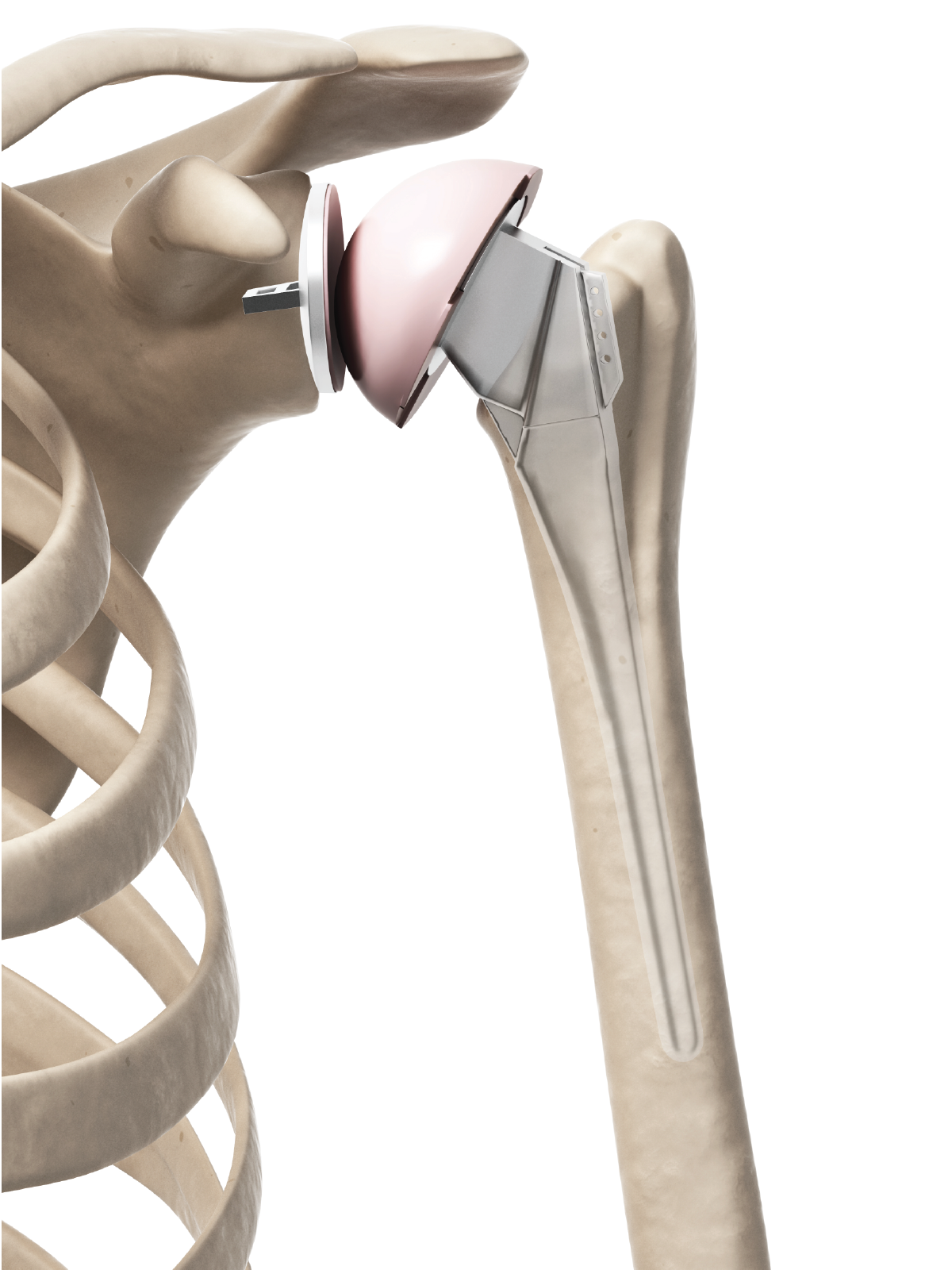 Joint Replacement | Thomasville Orthopedic Center, P.C.